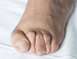 Hammertoe Surgery